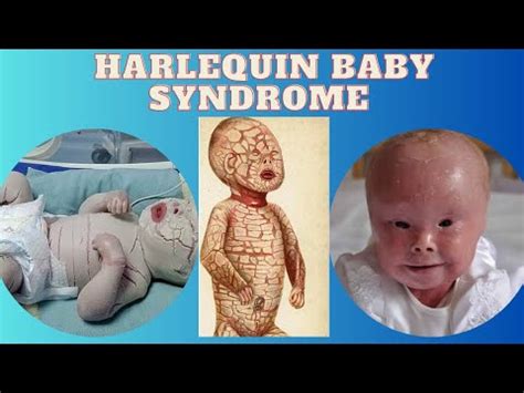 harlequin syndrome baby - festa baby shark